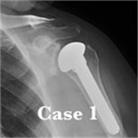 right total shoulder arthroplasty icd 10|Iba pa.